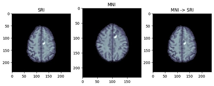 T1W_SRI_MNI_SRI_registered