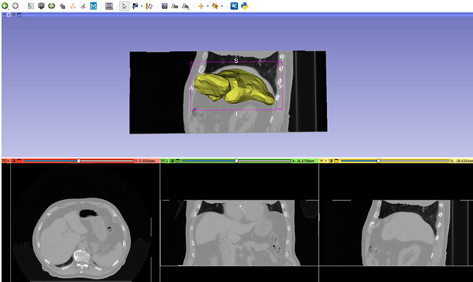 error_prone_case_liver_mesh_alignment